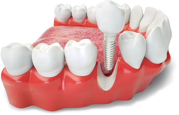 Implantes Dentais